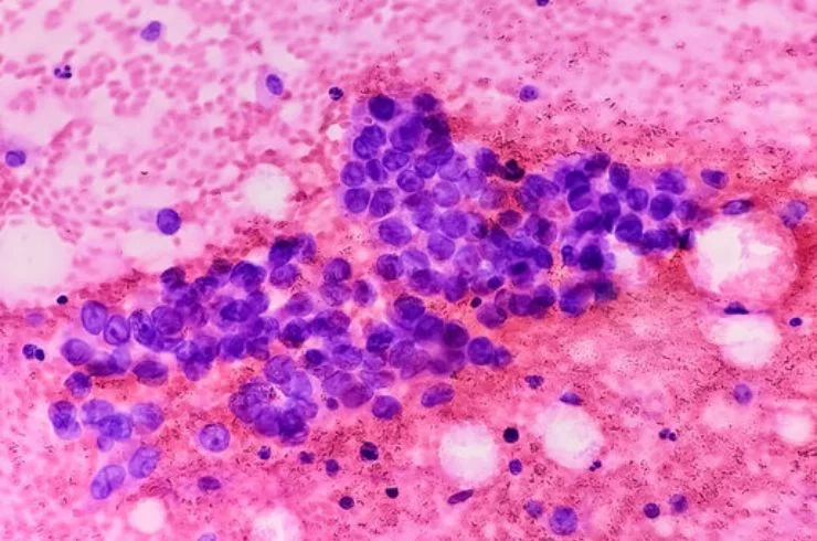 Cytology (Body Fluids, Sputum, and Urine)