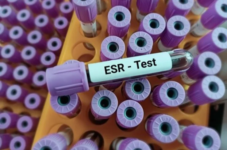 Erythrocyte Sedimentation Rate (ESR)