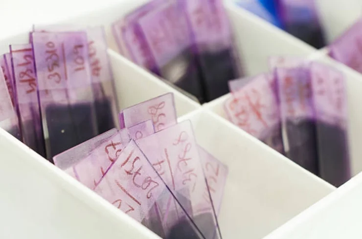 Peripheral Blood Smear (PBS) 