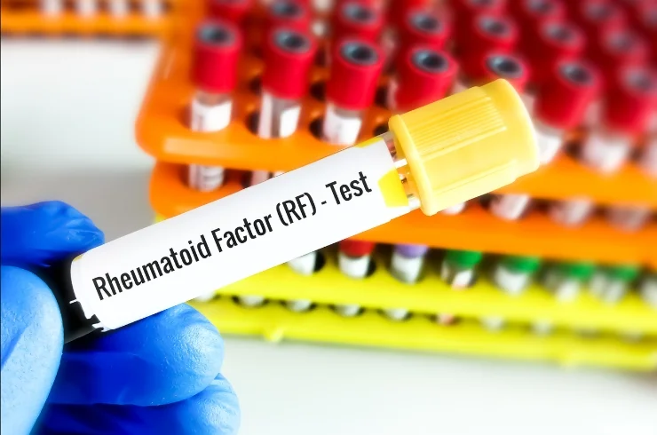 Rheumatoid Factor (RF)